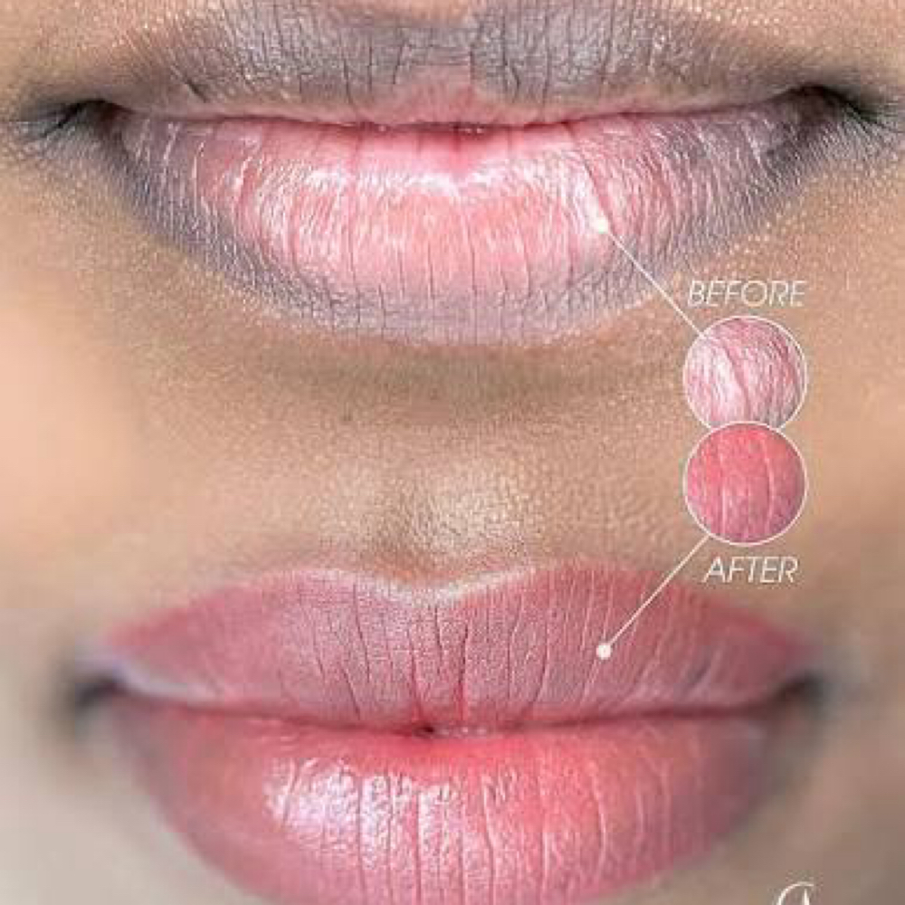 LIP NEUTRALIZATION (3rd SESSION ) at BEAUYBYJOJO PMU STUDIO in Plainfield, IL