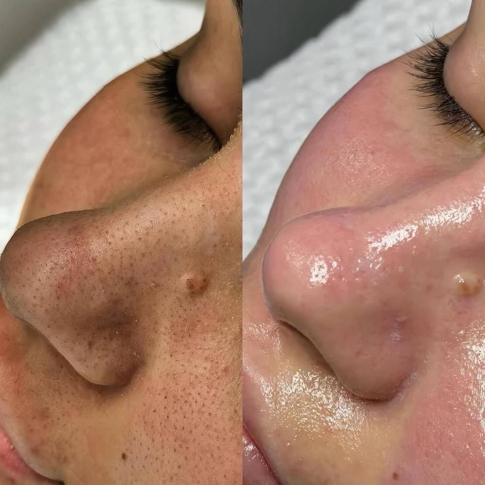 The Clear Skin Bundle ( 4 Facials) at Bellas Beauty Esthetics in California, CA