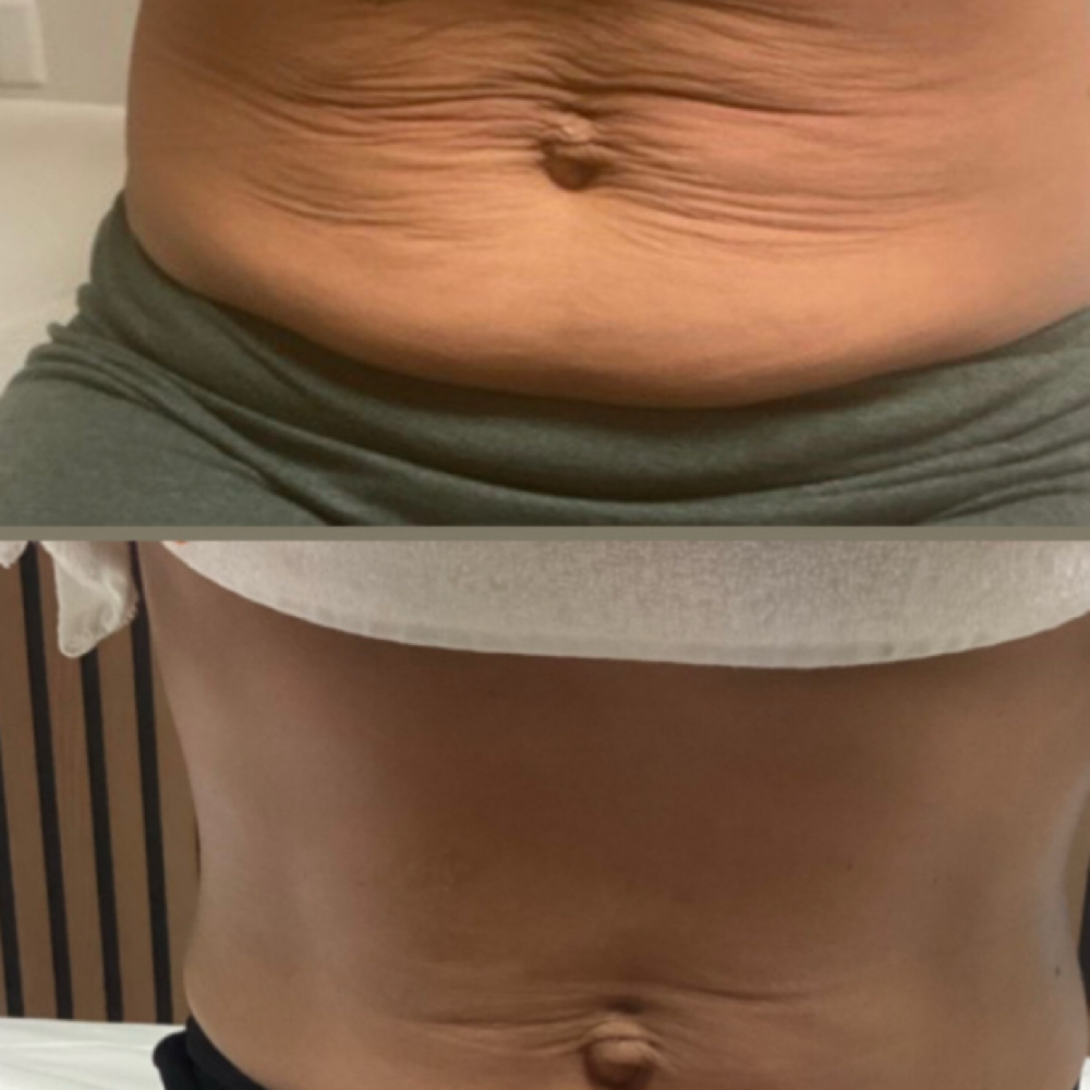 Signature ContourLift at Aesthetics By Aline in Danvers, MA