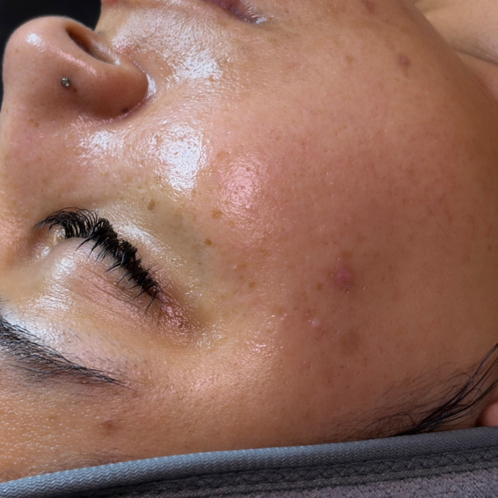 Custom Monthly Maintenance Facial at Glogetteresthetics in Warwick, RI