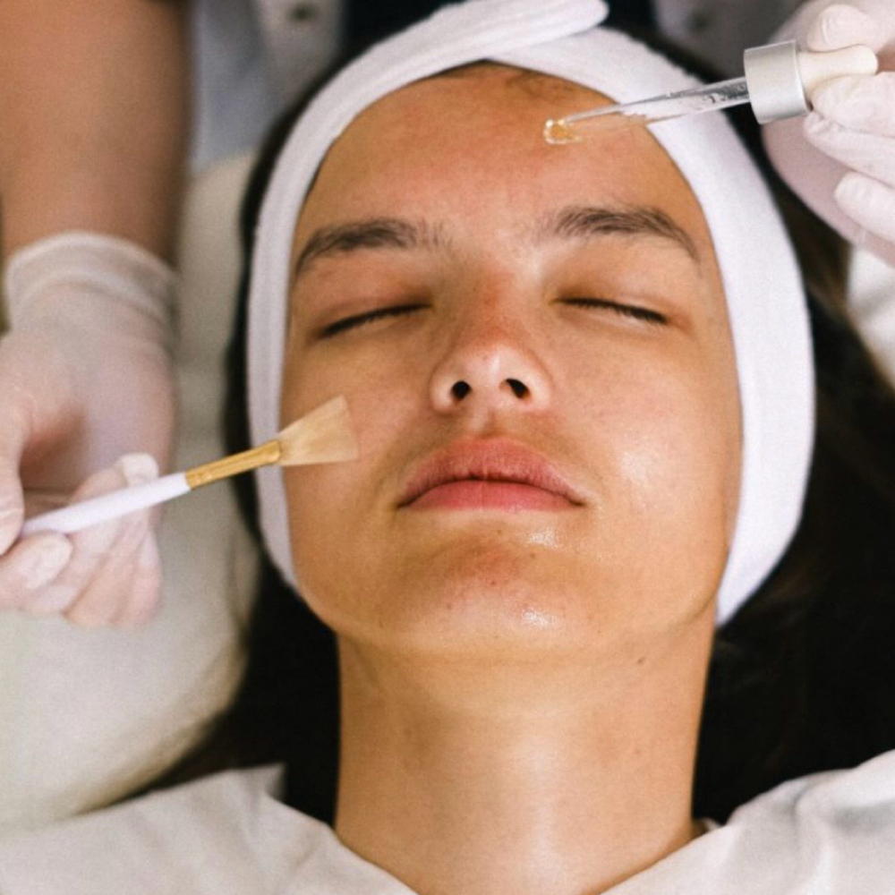 Chemical Peel ( Add On) at Glo by Mel in Ventura, CA