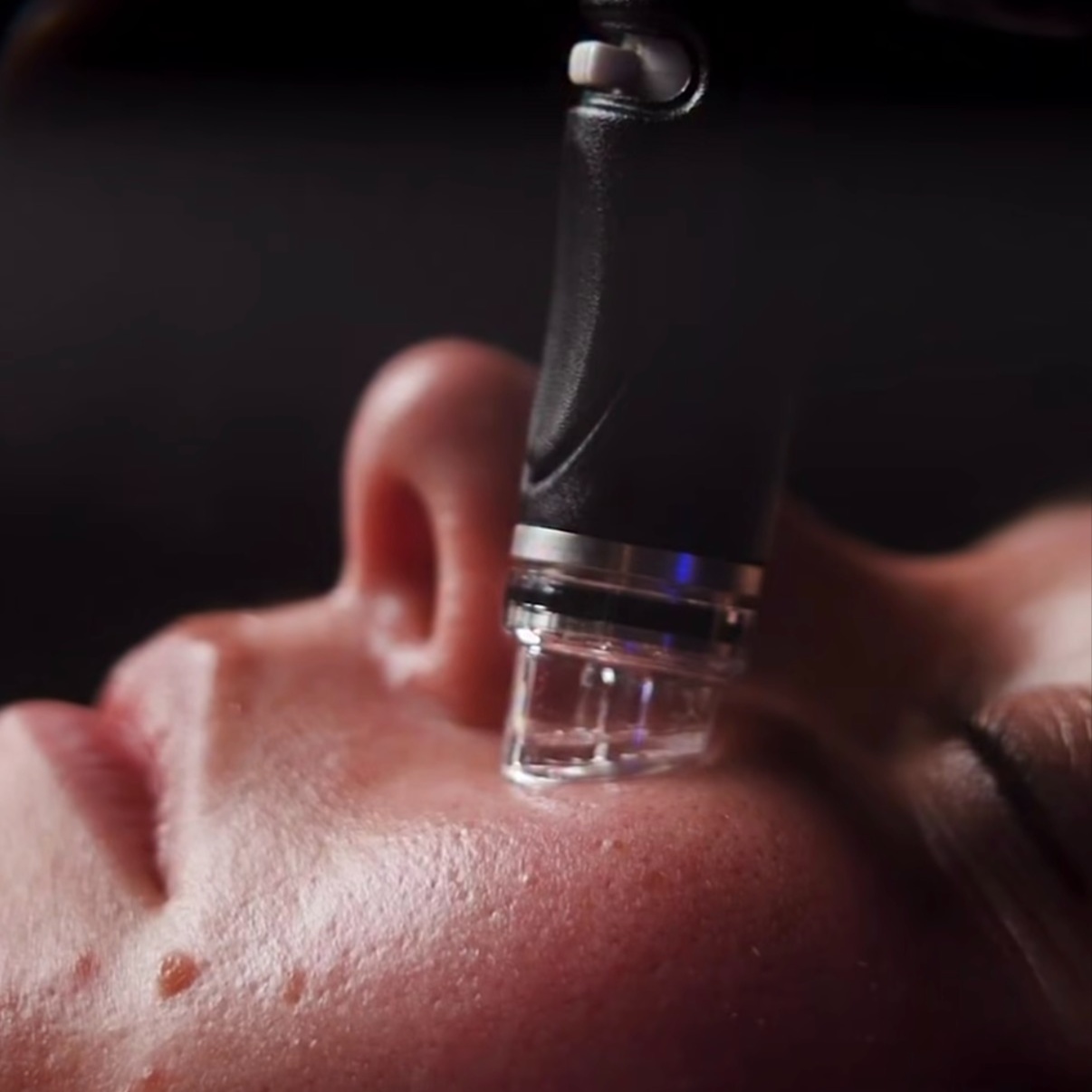 Teen Glow Hydrafacial™ at Skin Corrective Aesthetics in Dallas, TX