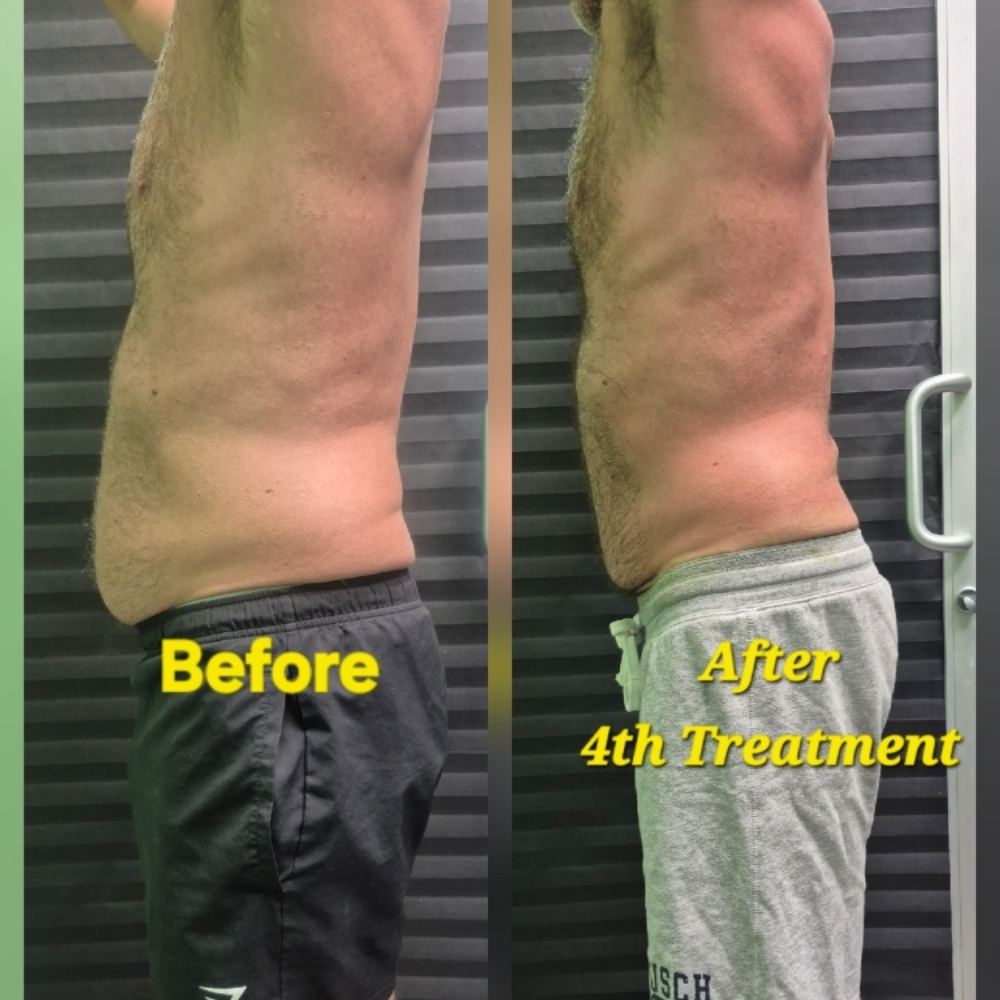 🌟4  Stomach Reduction Treatment at JUST BEAUTIFUL SKIN in Goose Creek, SC