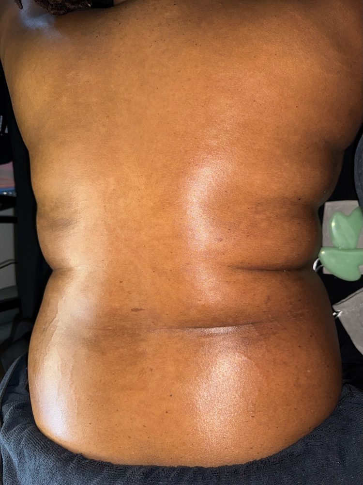 Back treatment