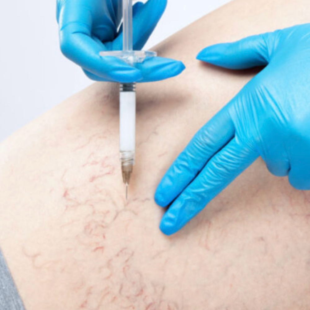 Sclerotherapy at Joelle Beauty and Wellness in Brownsville, TX