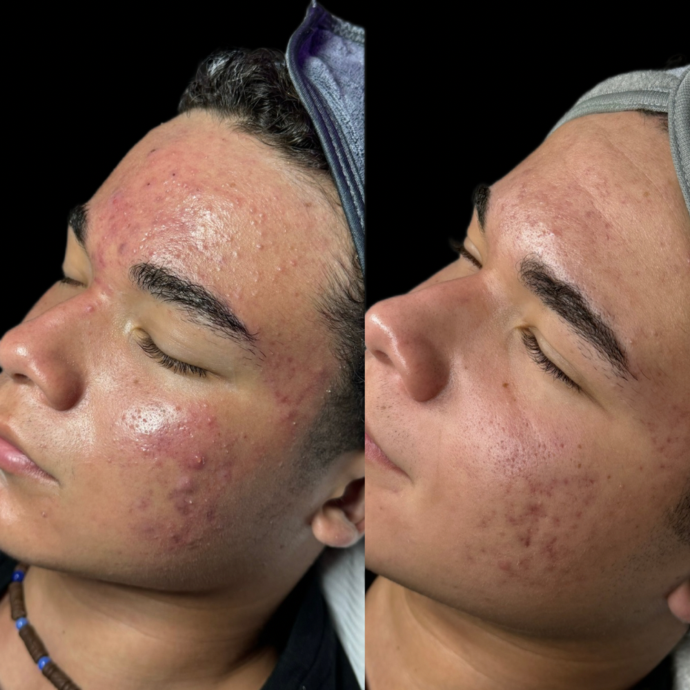 Anti Acne Package (4 Sessions)