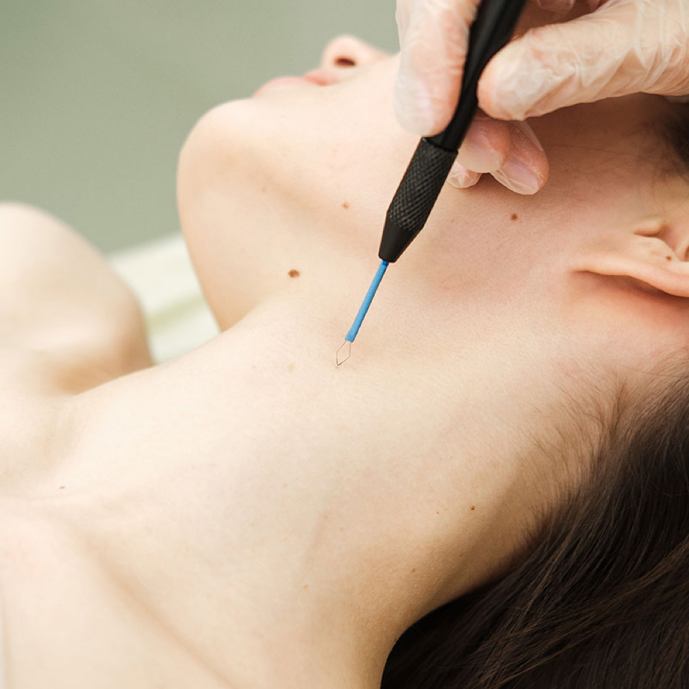 Skin Abnormalities Removal at B. Rucker Beauty Co. in Hendersonville, TN