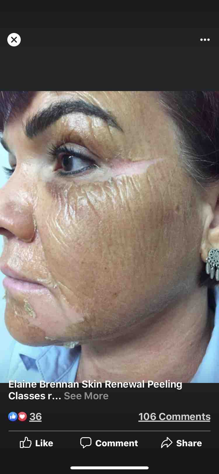 Vitamin A Peel Treatment