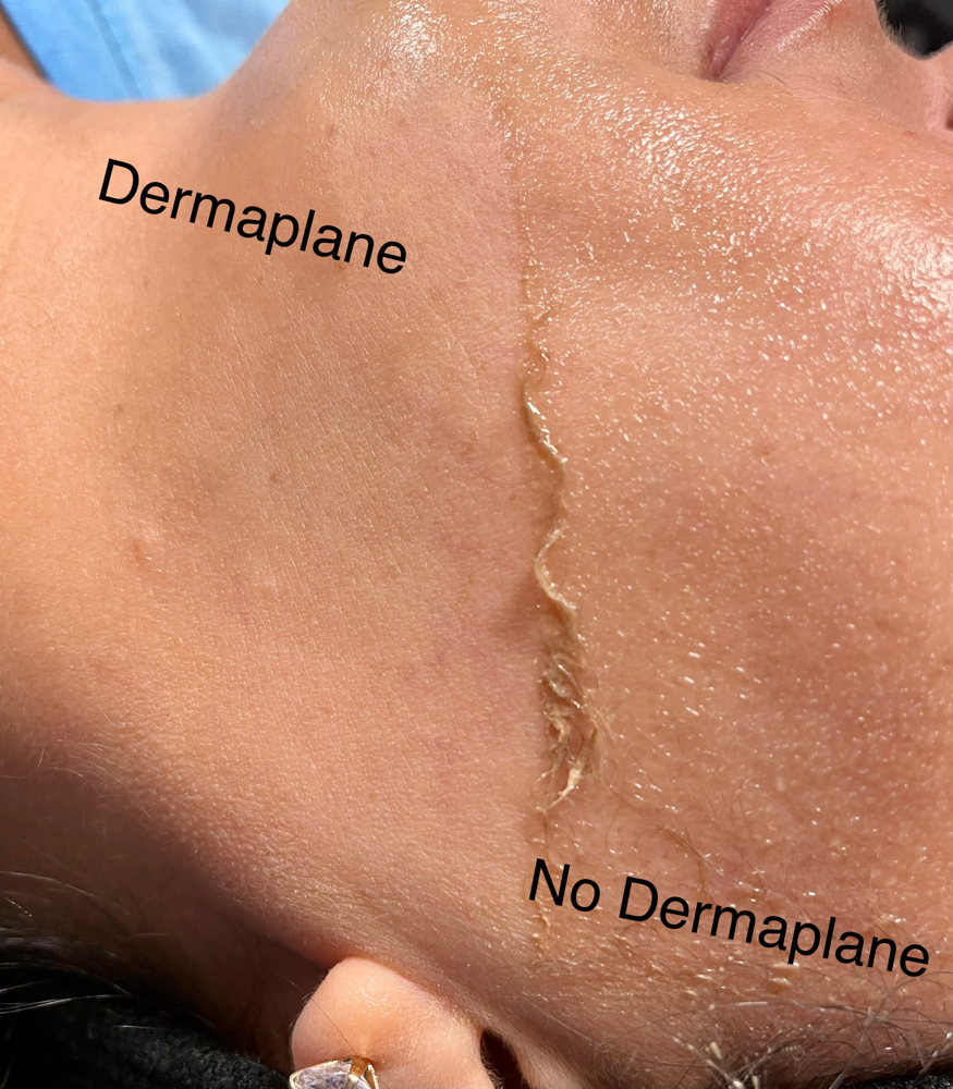 Dermaplane Add-on