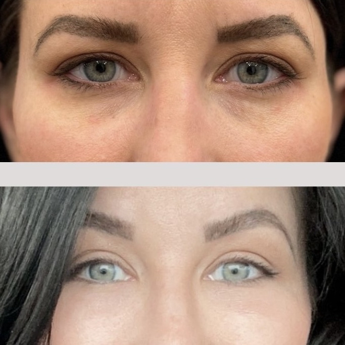 PRF: Under Eye Rejuvenation