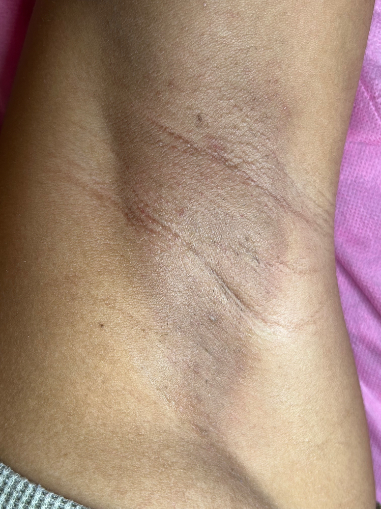 Underarms