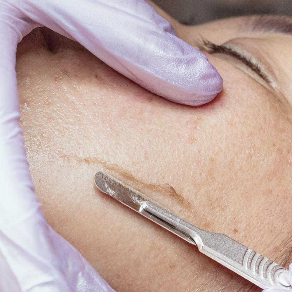 Dermaplaning | ADD ON