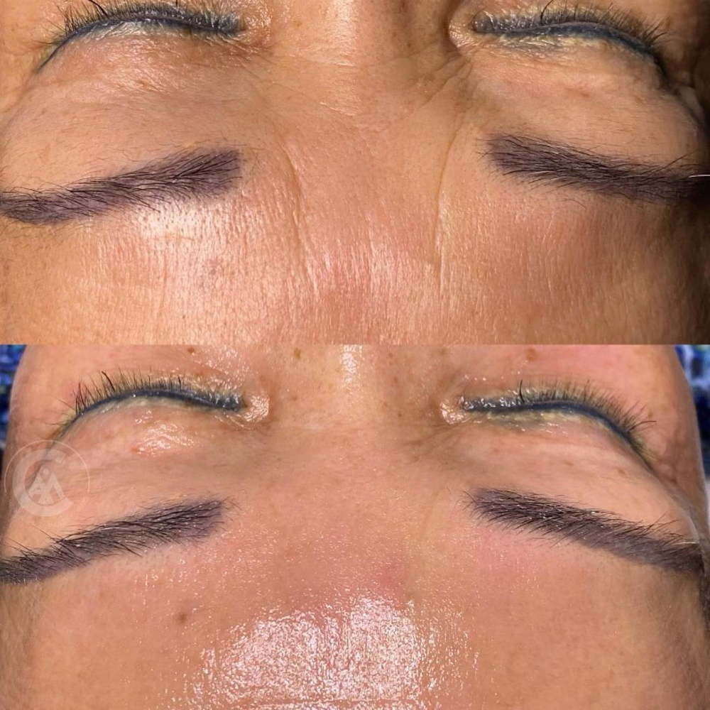 Needle Free Filler Facial