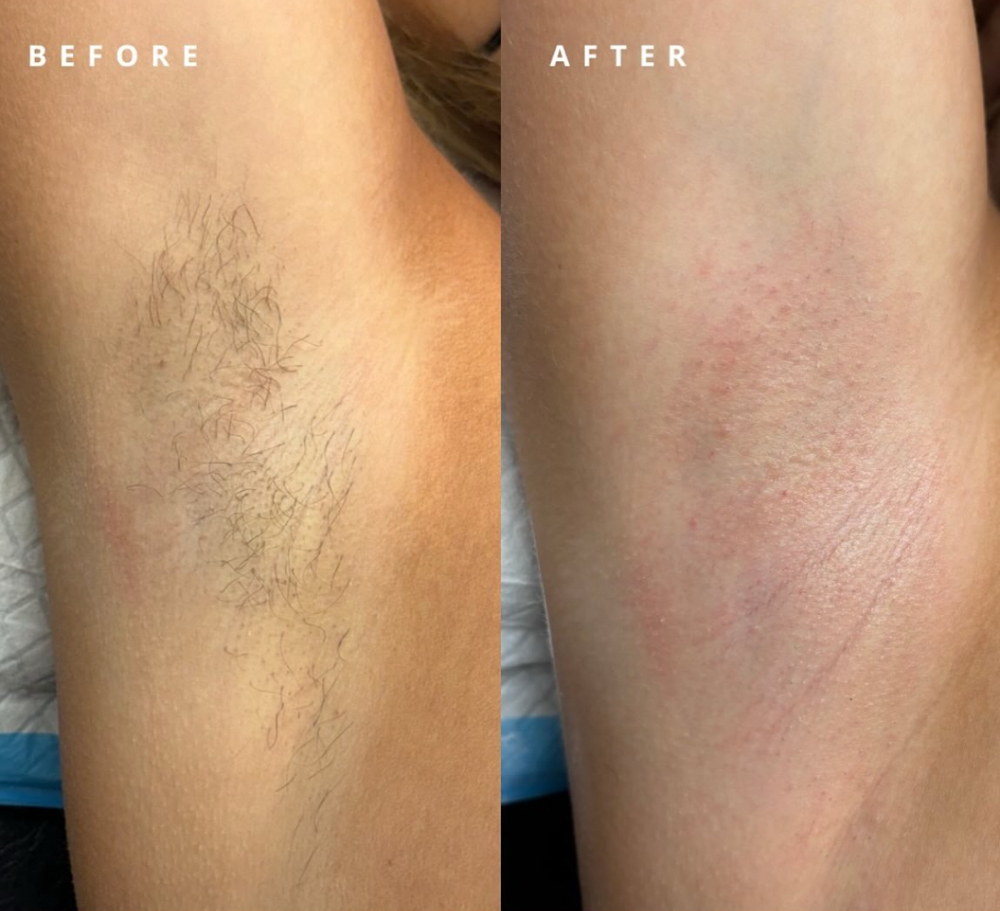 Under Arm Waxing at Sable & Sage Beauty in Saratoga Springs, NY