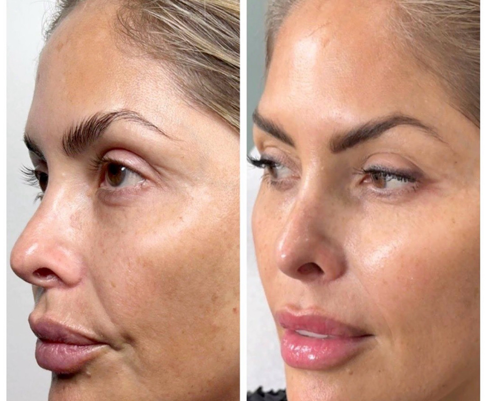 Rejuran - Repair Your Skin $600