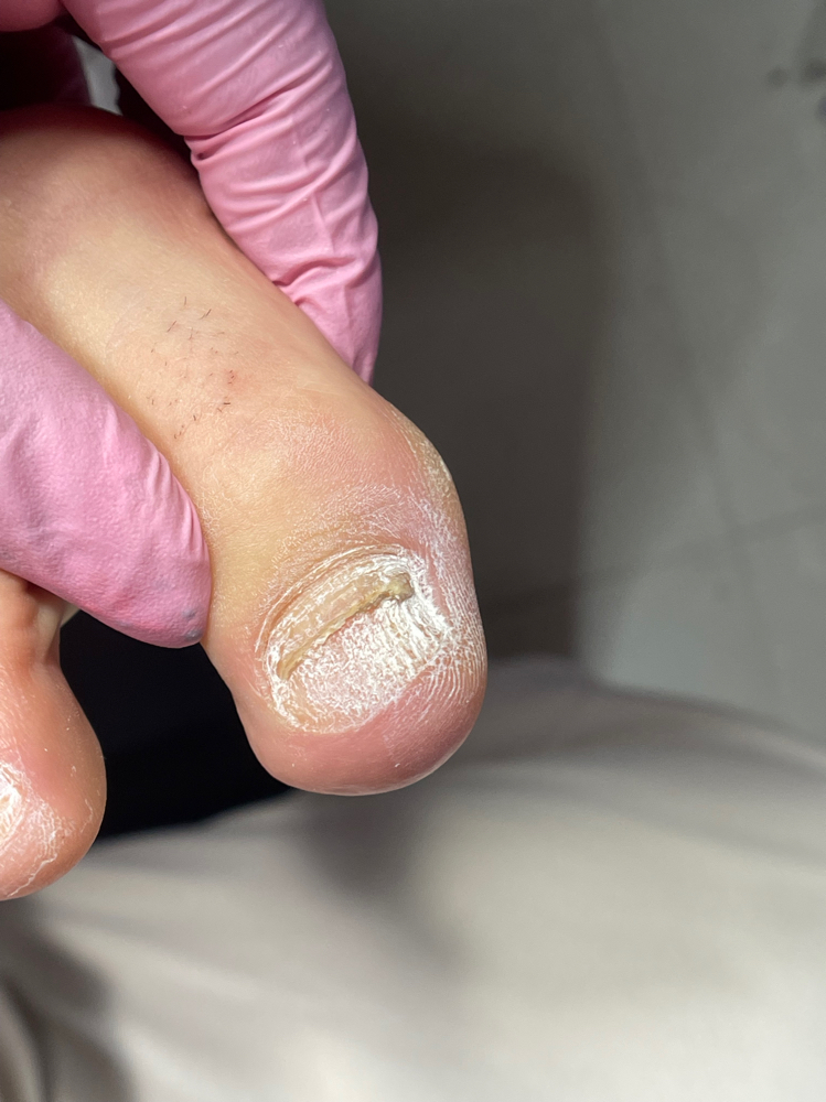 Seguimiento 3-4w Aceso Manos Y Pies