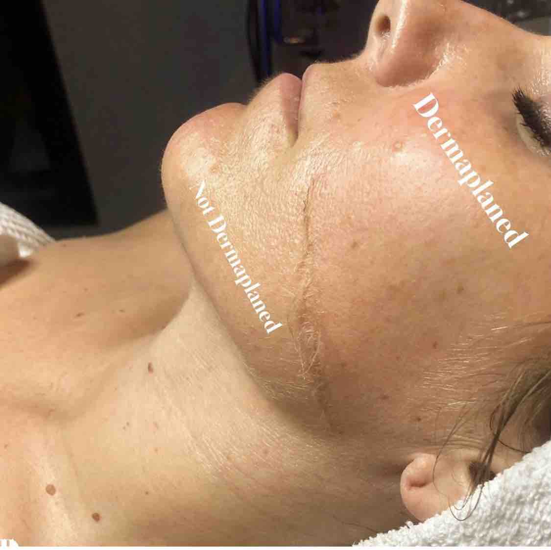 Dermaplaning + Facial (60-75 Mins)