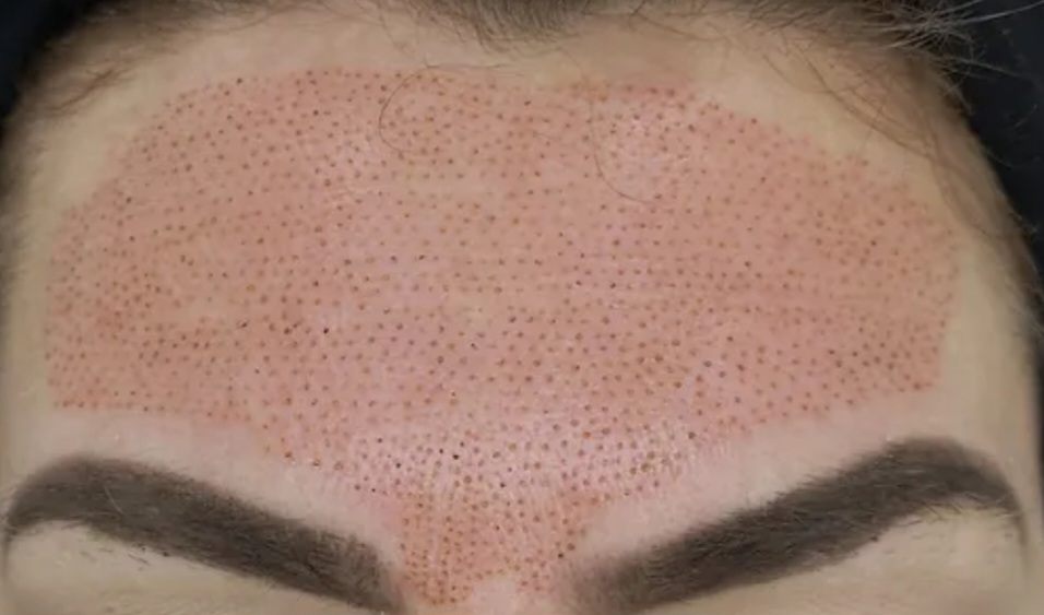 Plasma - forehead