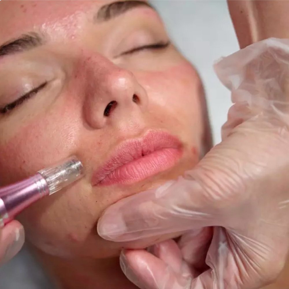 MICRONEEDLING at RGV PRIME AESTHETICS PLLC in Mcallen, TX