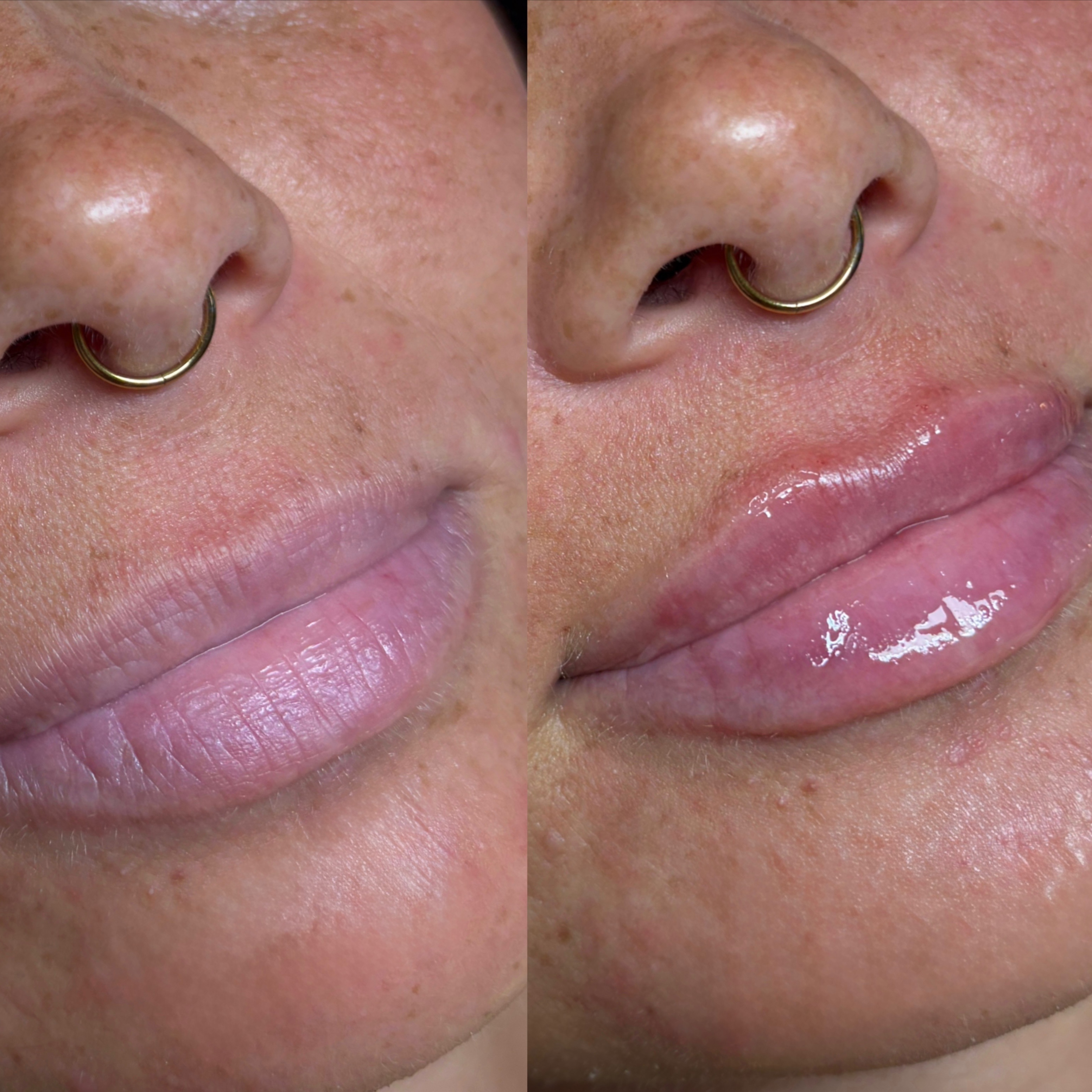 LEX LIPS | 0.5 at LEXTHETICS | Powered by Smiley Aesthetics & Dr. Katrina Briggs, MD in Columbus, OH