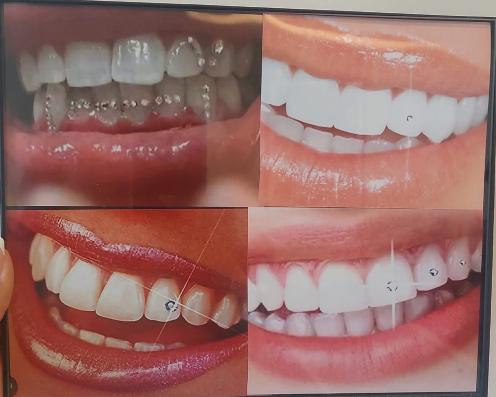 Tooth Gems at Beauty Esthetics Loft in Denver, CO