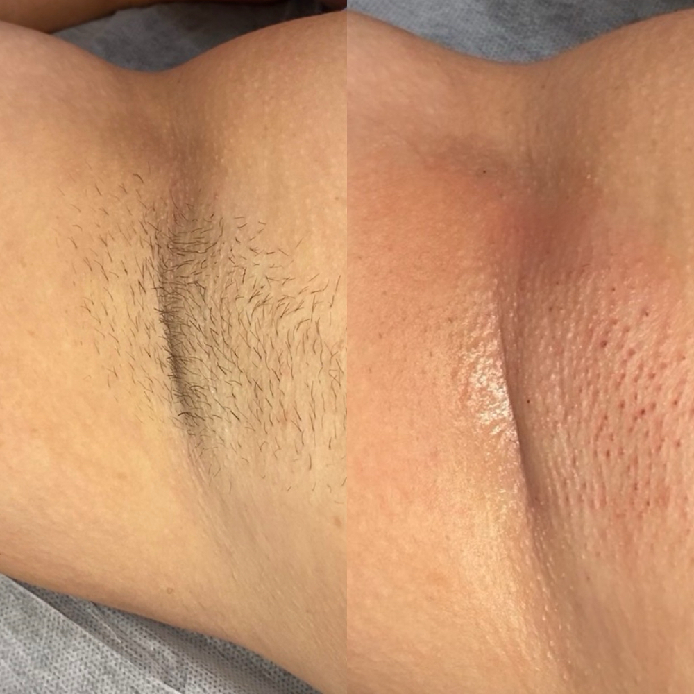 Female Underarm Wax