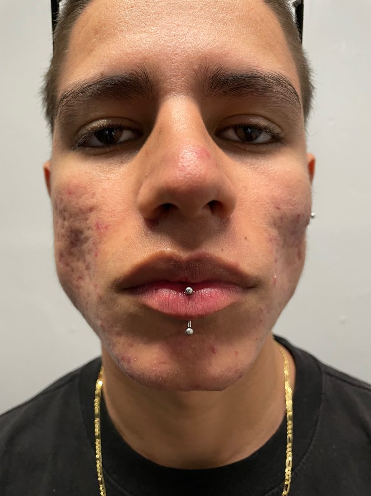 Vertical Labret Piercing