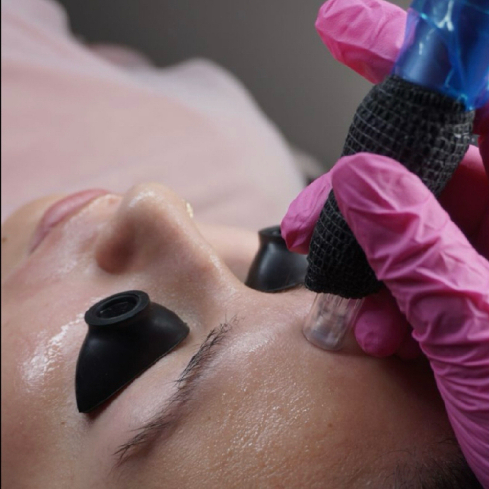 Nano-Needling Facial at Bare Esthetics by Chayse in Dayton, TN