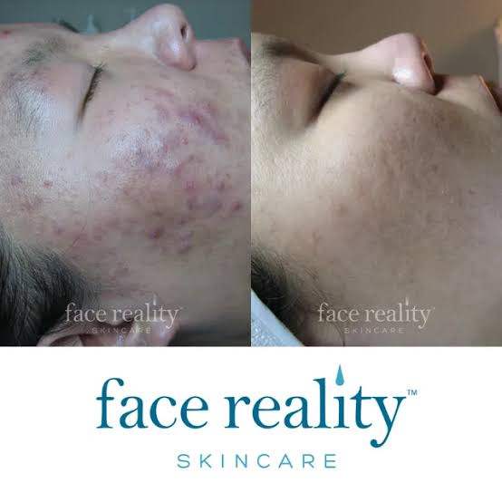 Acne Treatment + Consultation