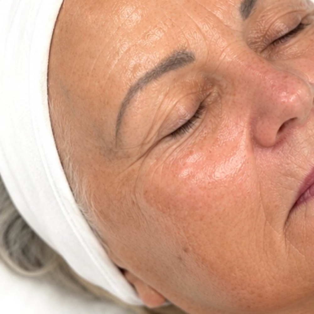 Skin Firming Rf Add-On at Destiny Aesthetics in Boise, ID