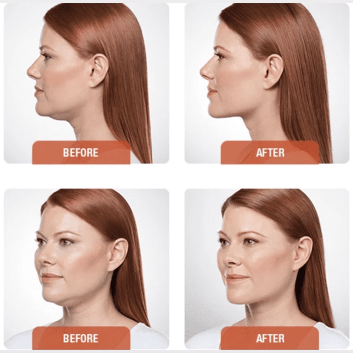 Lipo 360 Double Chin at Gold Stone Beauty in mcallen, TX