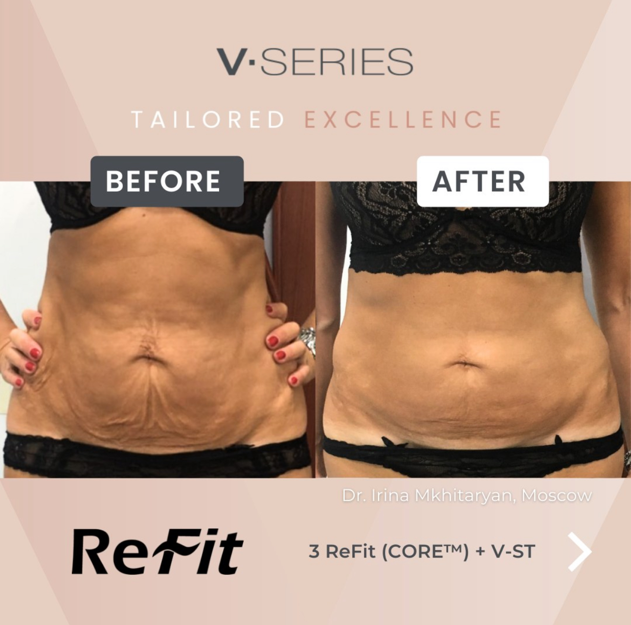 V-Form Body Skin Tightening at Magnifique Laser Spa in Rockville Centre, NY