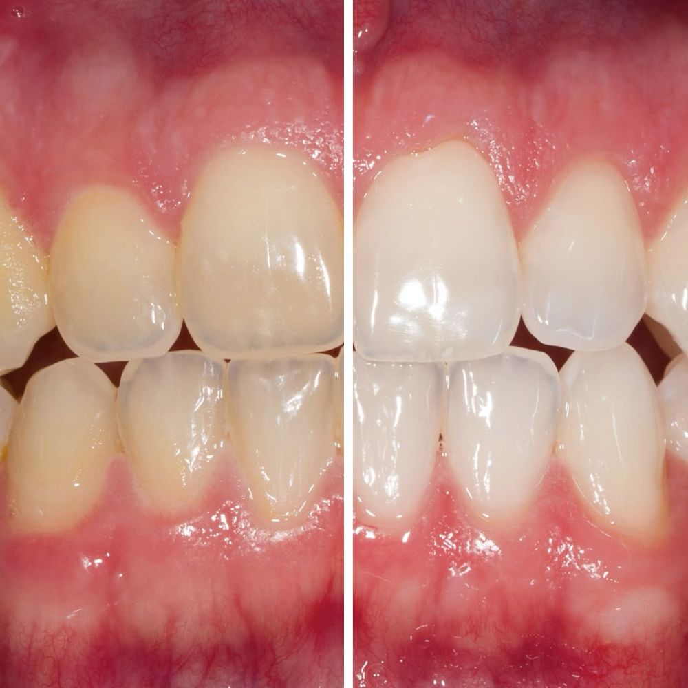 Teeth Whitening