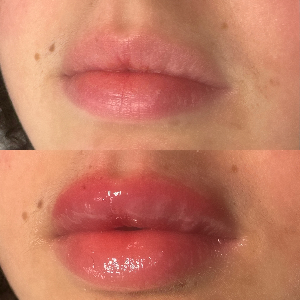 Needle-less Lip Filler
