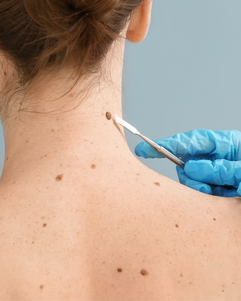 Skin Imperfections Removal at Glow Beauty Studio in Sugar Hill, GA