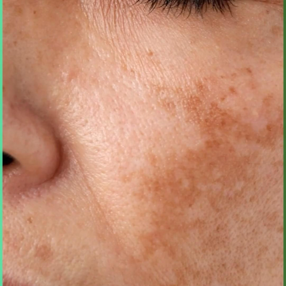 Melasma ( Sessao ) at Jessica Luchesi Skin Wellness in Elizabeth, NJ