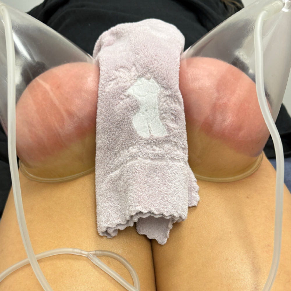 Vacuum Butt Lift at Luxe Contour in Ontario, CA