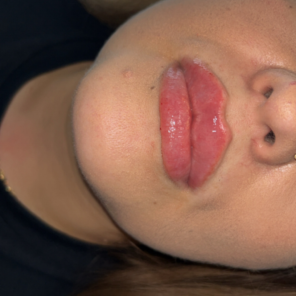 Micro Needling 1ml Lip Filler at Kat Marie Aesthetics in Humble, TX