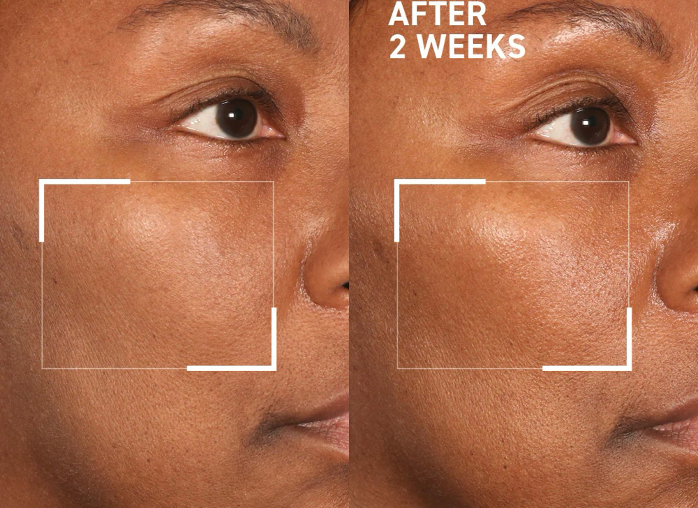 Microdermabrasion at Unspoken Beauty Aesthetics in Port Saint Lucie, FL