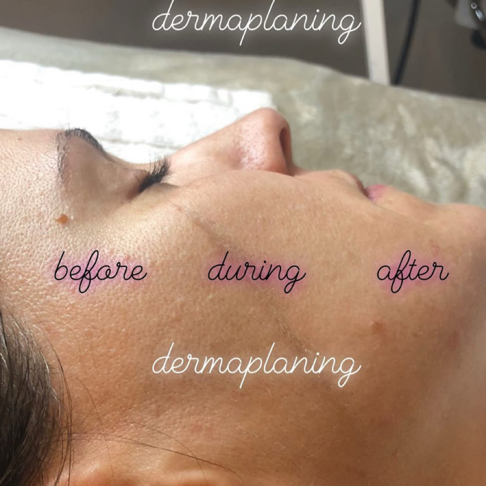 Dermaplaning at SkincareMary at Spa Revenir in Winchester, MA