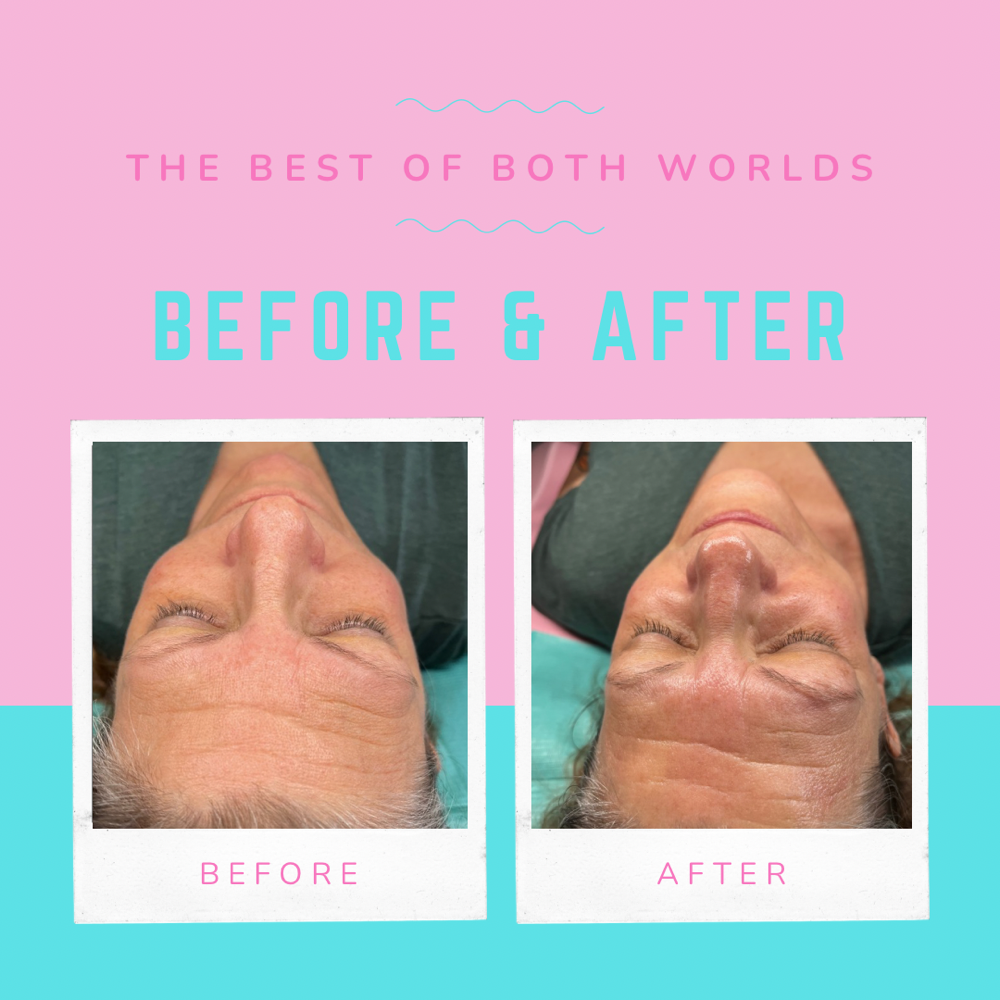 Aging “Backwards” Facial