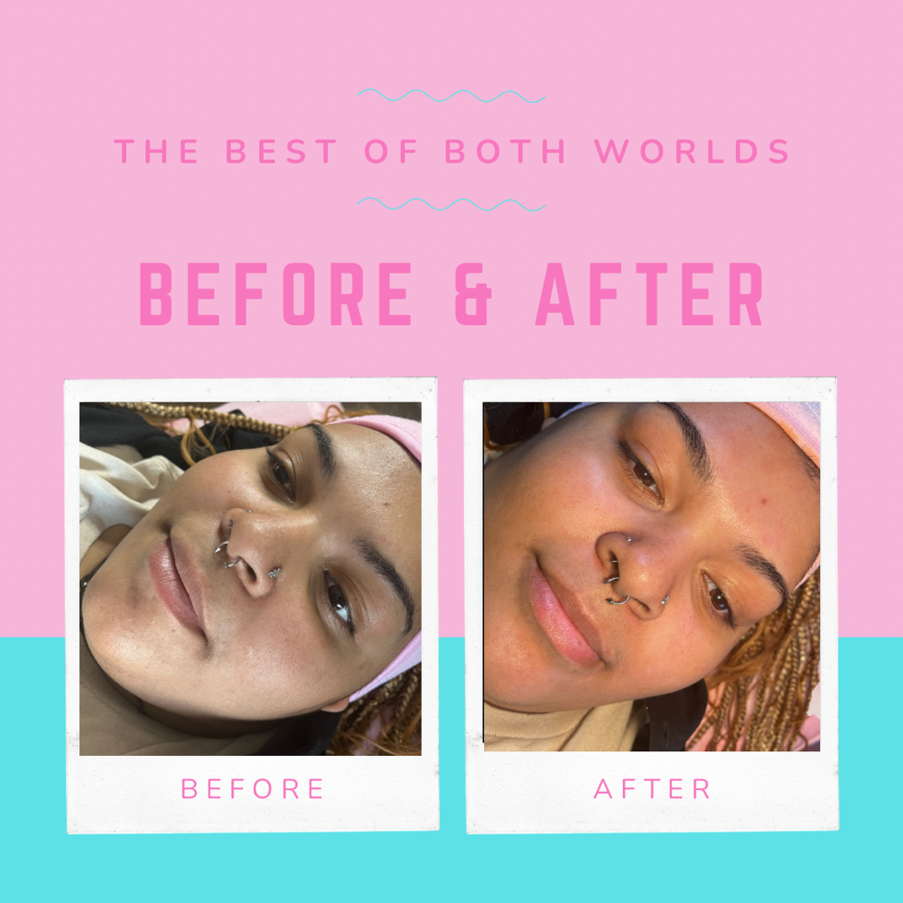 Aging “Backwards” Facial