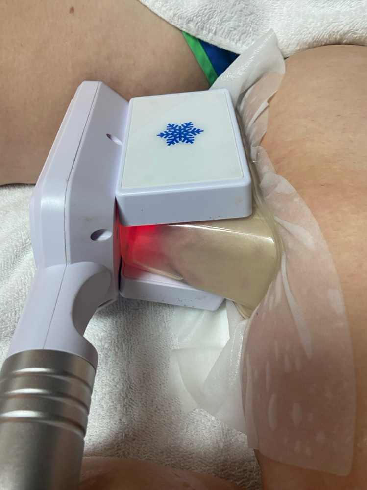 Fat Freezing Follow Up
