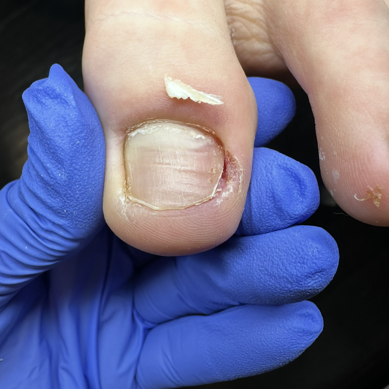 Complex Toenail Care 1st Category