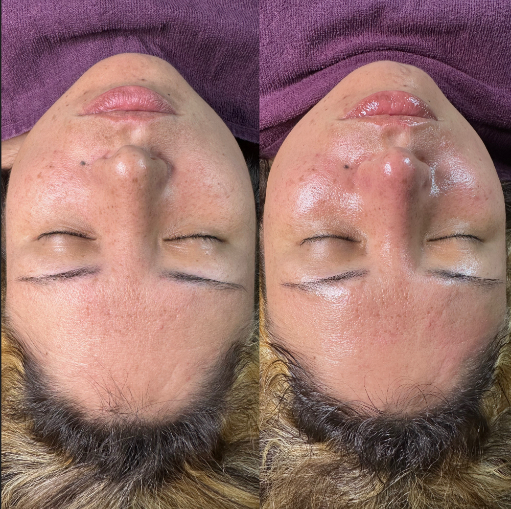 Microdermabrasion