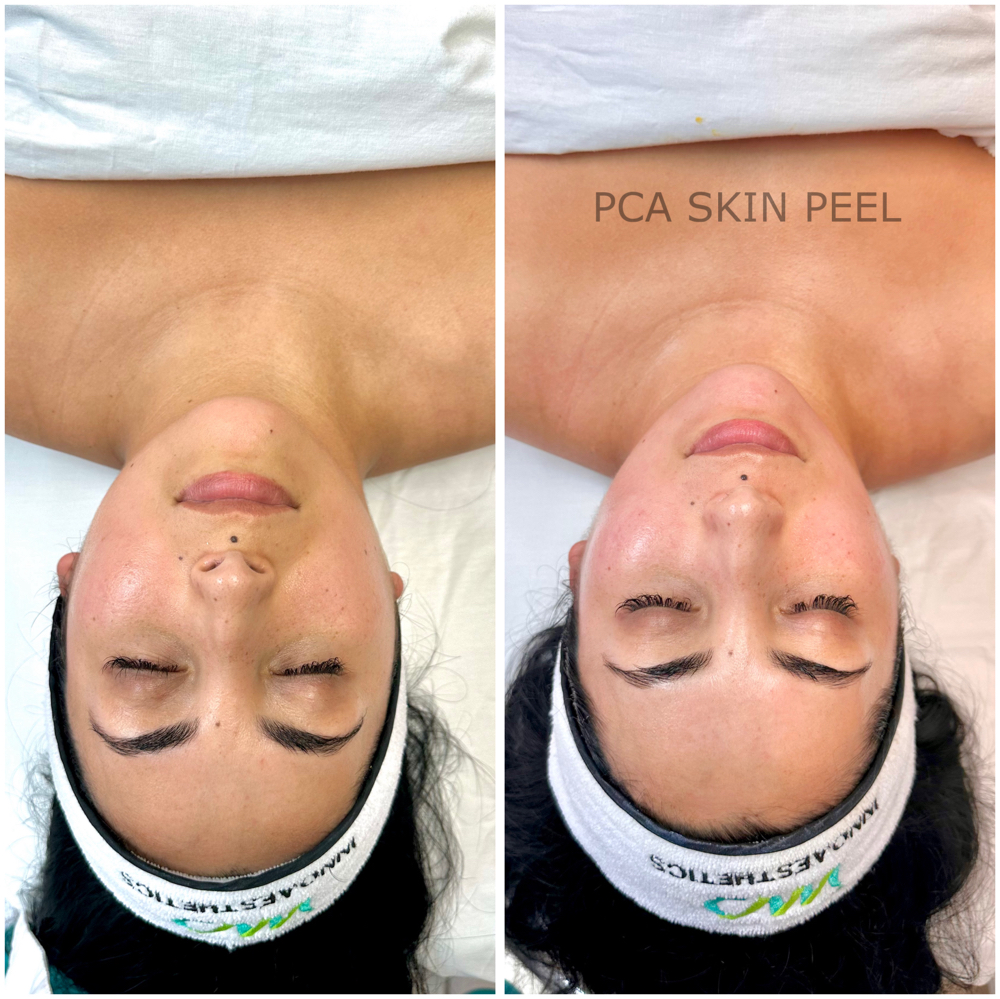 Skin Peel