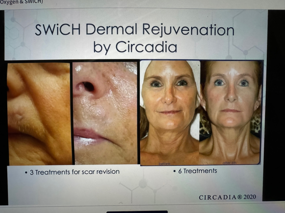 Swich Dermal Rejuvenation Facial