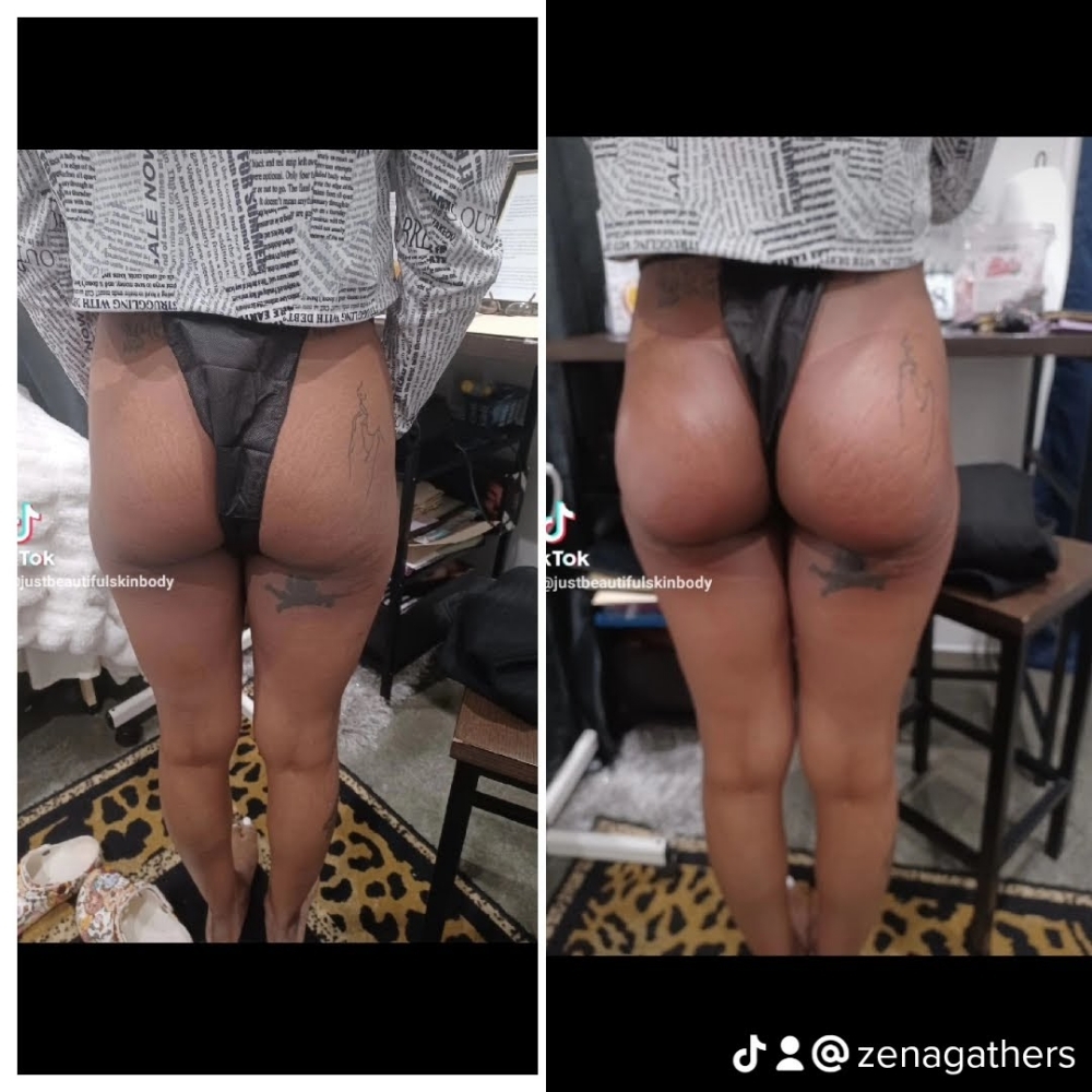 🍑 Butt Lift at JUST BEAUTIFUL SKIN in Goose Creek, SC