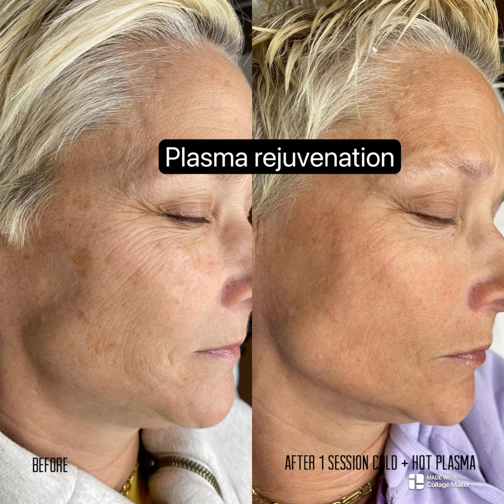 Cold Plasma Rejuvenation