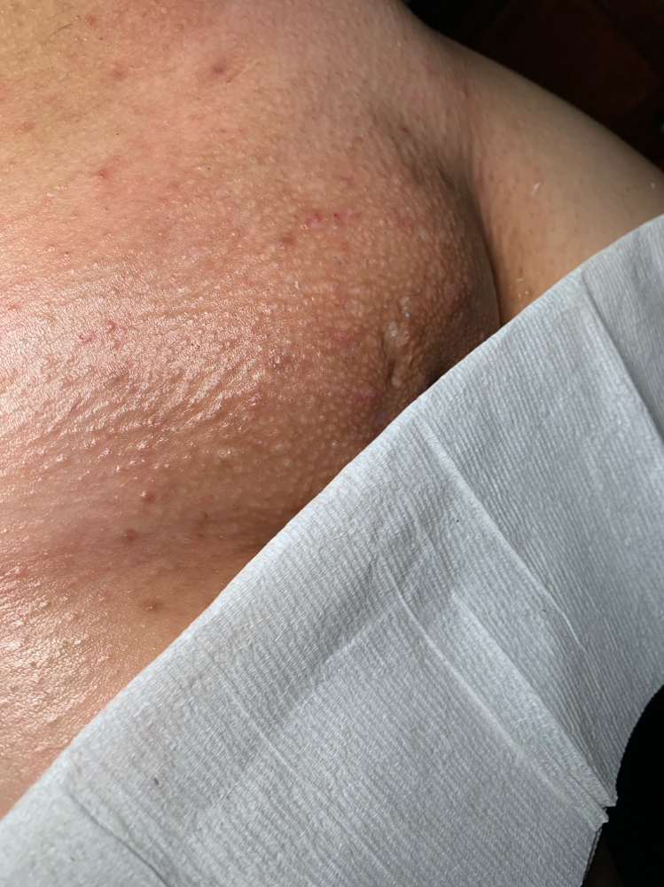 Half Brazilian Wax (bikini)